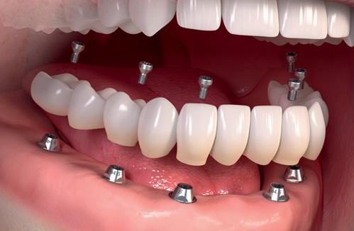 Dental Implant in Oakville