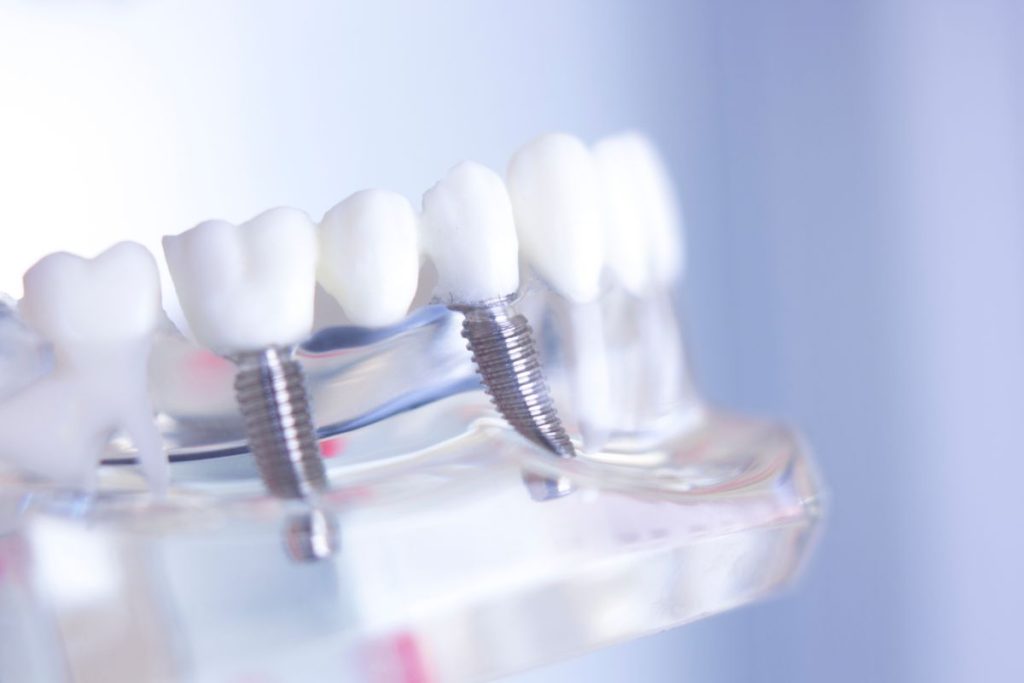Dental Bridge in Oakville