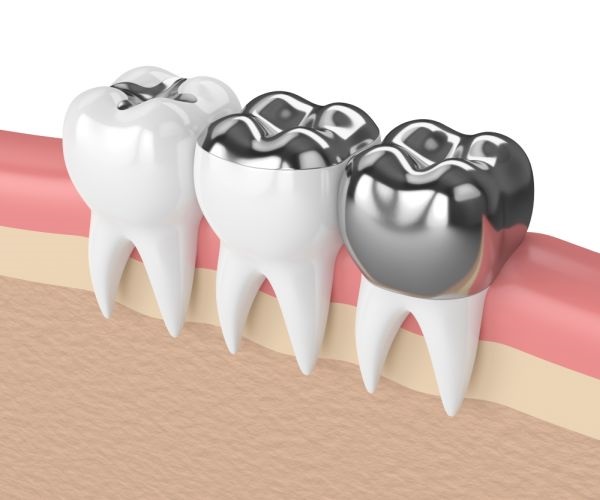 Dental Crowns in Oakville