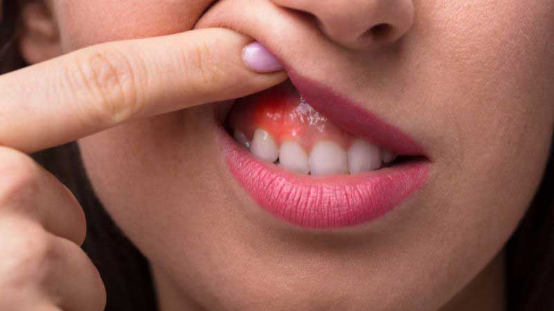 Teeth Cleaning in Oakville