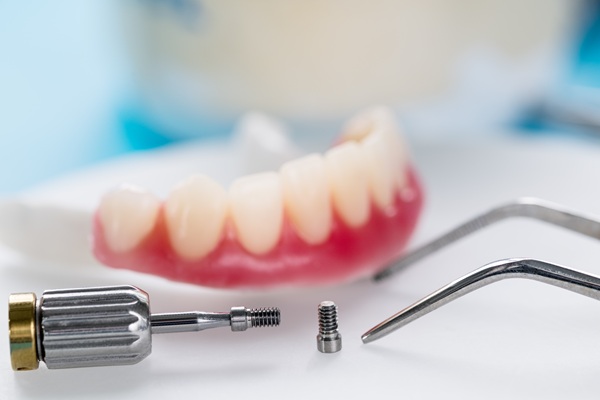 Dental Implant in Oakville