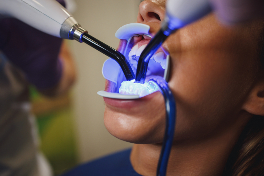 Teeth Whitening in Oakville