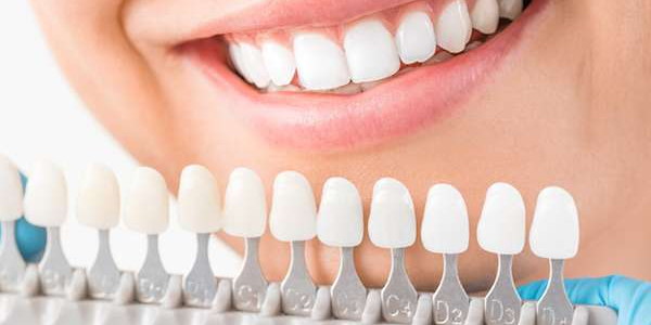 Dental Veneers in Oakville