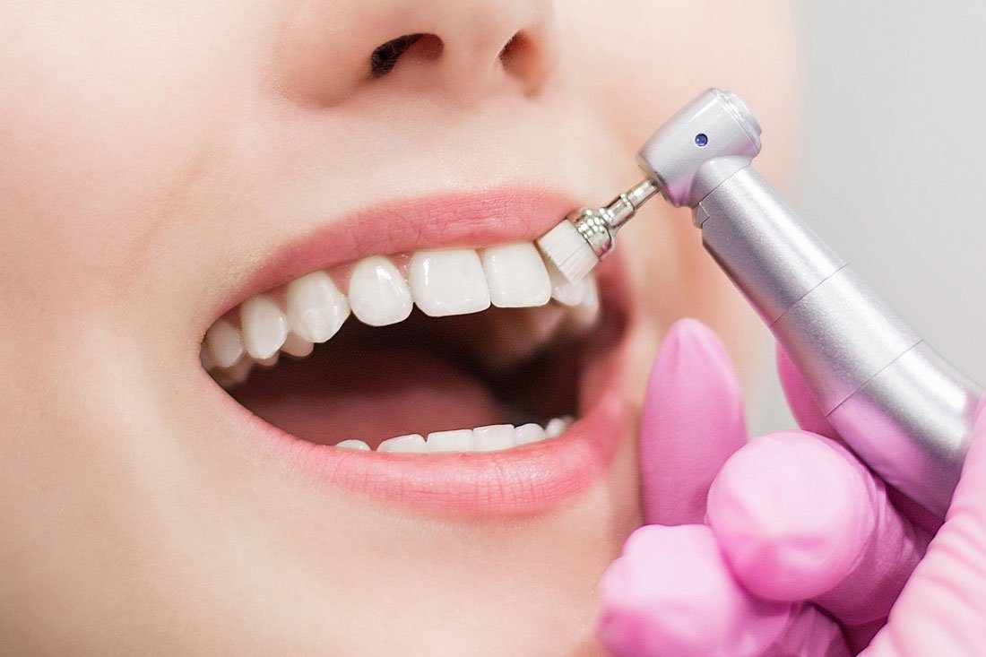 Teeth Whitening in Oakville