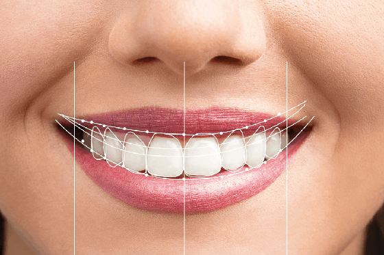 Smile Makeover in Oakville