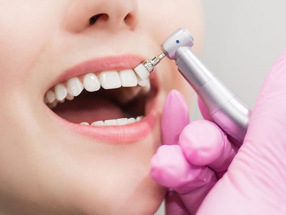 Professional dental cleaning removing surface stains after teeth whitening in Oakville