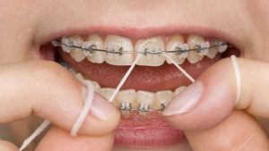 Flossing with braces