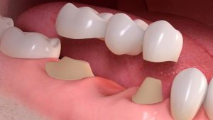 Dental Bridges