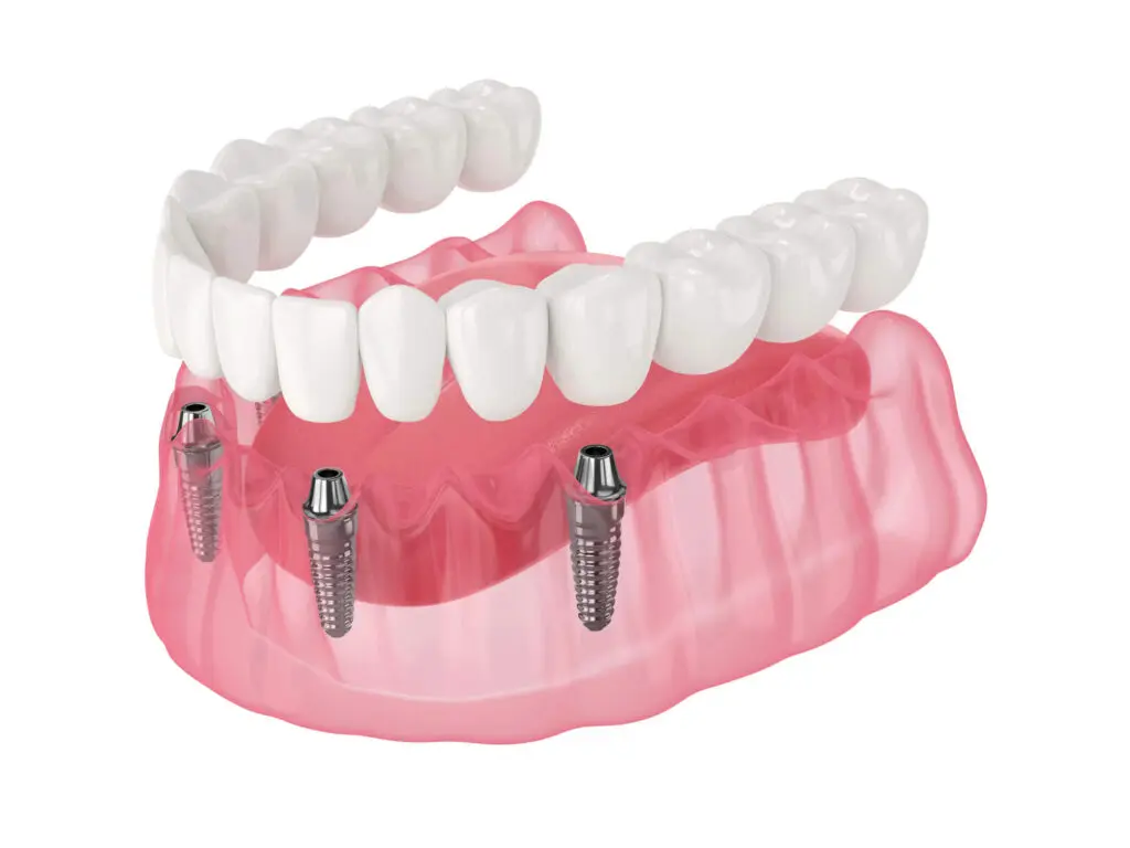 All-on-X dental implants