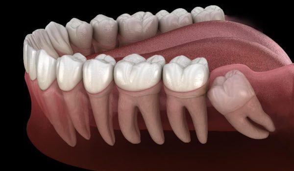 Wisdom Tooth Extractions in Oakville