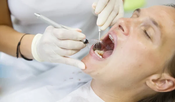 Root Canal Treatment in Oakville